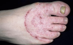 Razlozi pojave gljivica na nogama