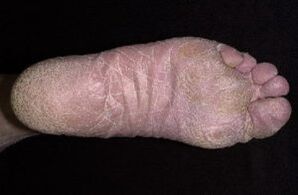 Znakovi i simptomi gljivica na nogama