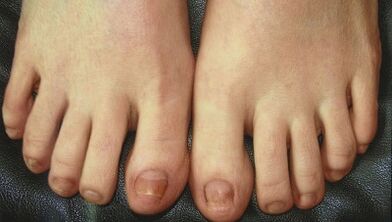 Faze razvoja gljivice za nokte