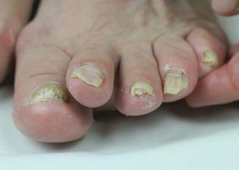 liječenje gljivica na noktima lijekovima