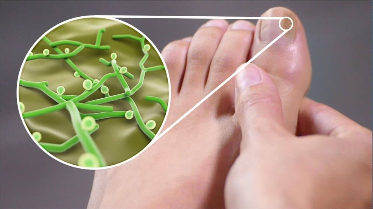 uzročnici gljivica noktiju na nogama