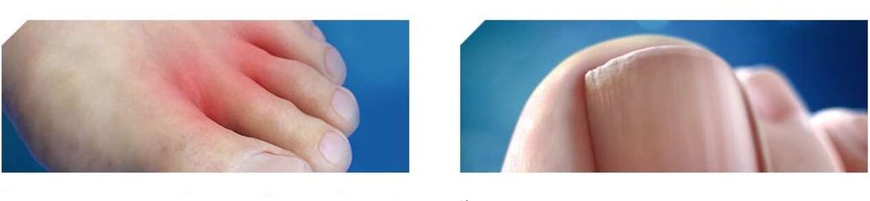 početna faza gljivica stopala